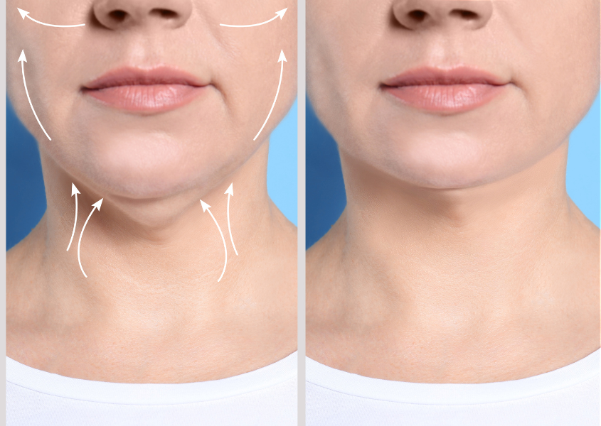 face yoga for double chin before and after